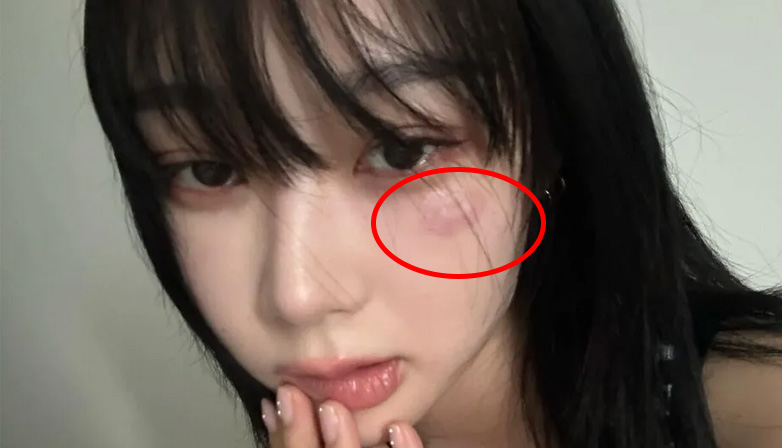 aespa Giselle’s bruise. | TheQoo